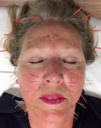 Facelifting mit Akupunktur
